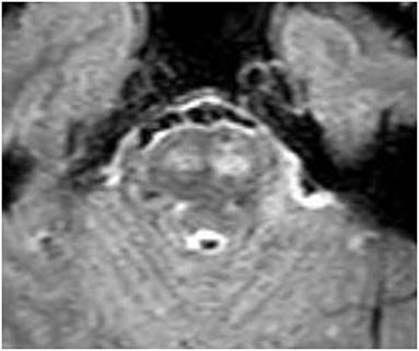 Refractory Central Neurogenic Hyperventilation: A Novel Approach Utilizing Mechanical Dead Space